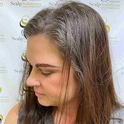 Scalp Micropigmentation | Female